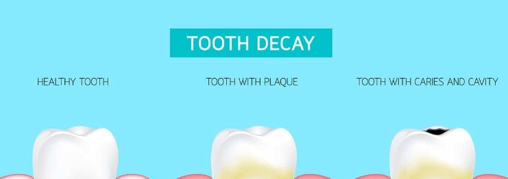 Understanding Tooth Decay and Cavities