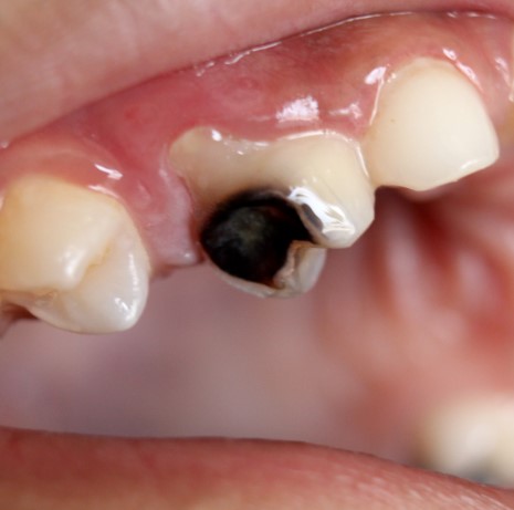 Understanding Tooth Decay And Cavities, dental caries, oral health issues, cavity prevention, dental decay comprehension, decay and cavity awareness, tooth erosion understanding, oral hygiene awareness, dental health knowledge, tooth deterioration comprehension, dental cavity understanding, tooth decay knowledge, oral care awareness, dental erosion awareness, cavity management, dental health comprehension, tooth decay awareness, oral health education, cavity prevention insights, dental decay awareness, tooth deterioration knowledge, oral hygiene comprehension, dental cavity knowledge, understanding oral health issues, decay and cavity education